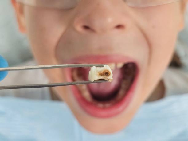 Best Emergency Broken Tooth Repair in Oceanside, NY